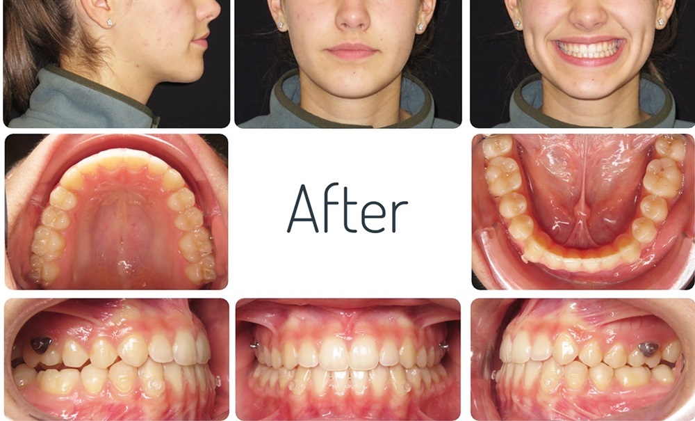 Off the Hook: Clear aligner attachments